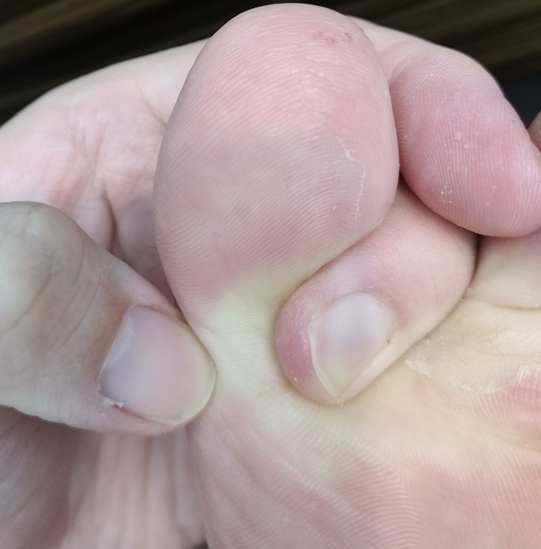 Toe_eczema_3